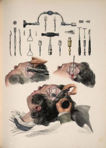 ANTIQUE MEDICAL SURGICAL TREPHINING TOOLS A3 RE PRINT