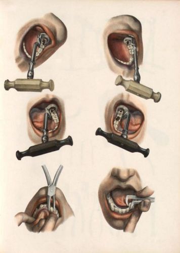 ANTIQUE MEDICAL DENTAL EXAMPLES OF TOOTH KEY EXTRACTION  A3 RE PRINT