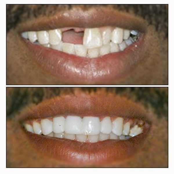 TEMPORARY TOOTH REPAIR or REPLACE KIT DIY makes 25-30 teeth *No Adhesive needed