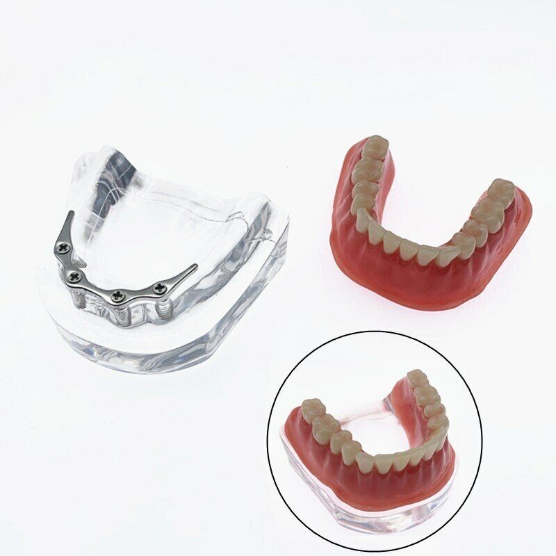 Repair teeth model with implant with Silver Bar Denture Teeth mandibular model 