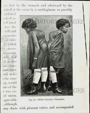 1928 Press Photo Drawing of Siamese twins Millie and Christine - nei51285 picture