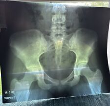 Lot of 70 X-Ray CT Film Pieces Oddity Medical Surgical Spinal Fusion Skull Ribs picture